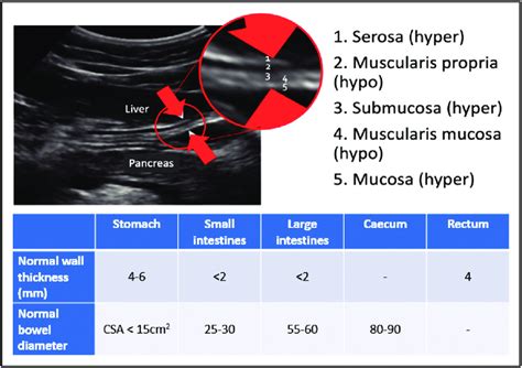 measurement of small intestine thickness|Normal small bowel wall characteristics on MR enterography.